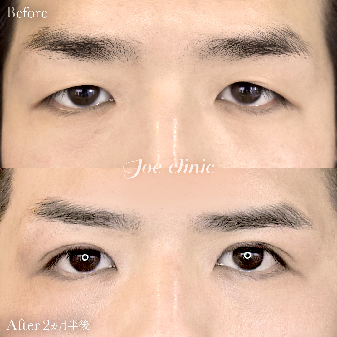 【20代男性】眼瞼下垂（挙筋短縮全切開法）＋脂肪取り術｜2ヵ月半後