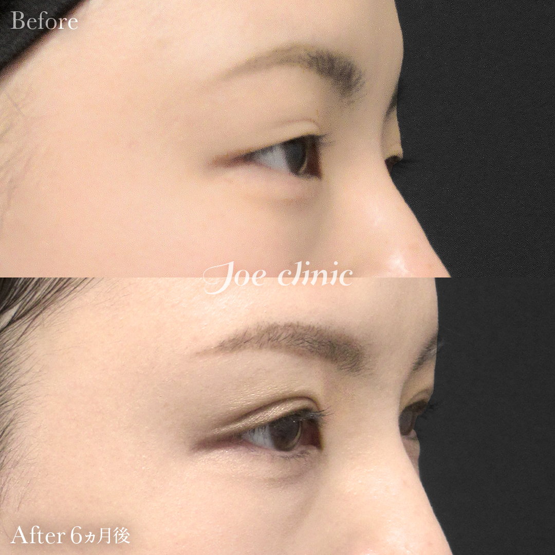【30代女性】眼瞼下垂（挙筋短縮部分切開法）+脂肪取り術+他院埋没糸取り｜6ヵ月後