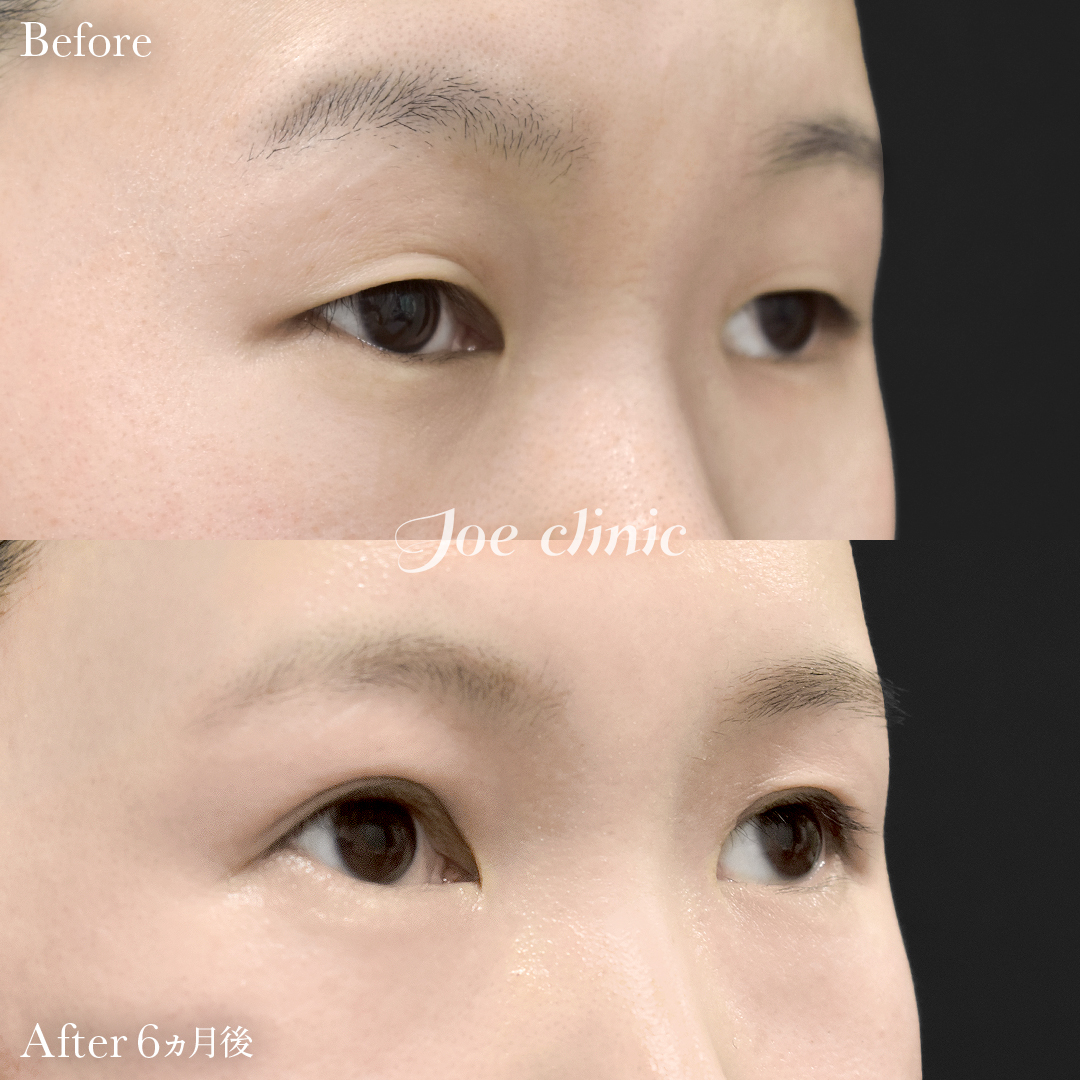 【20代女性】眼瞼下垂（挙筋短縮全切開法）＋脂肪取り術｜6ヵ月後