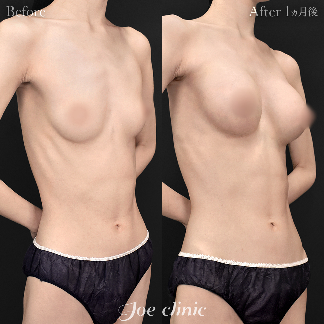 【20代女性】シリコンバッグ豊胸モティバ2（270cc×左右）｜1ヵ月後