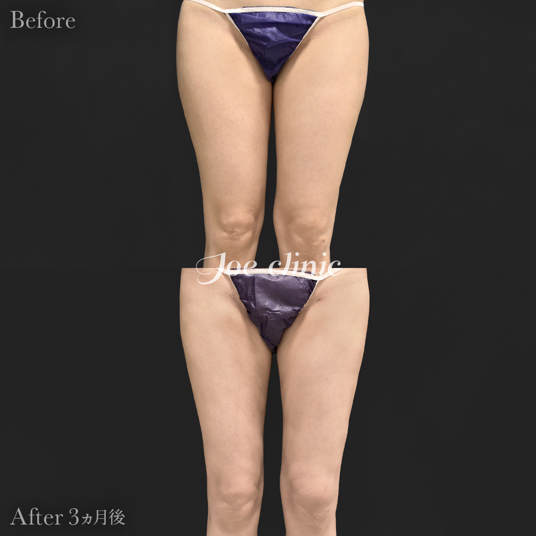 【20代女性】脂肪吸引（大腿全周＋膝周囲）｜3ヵ月後