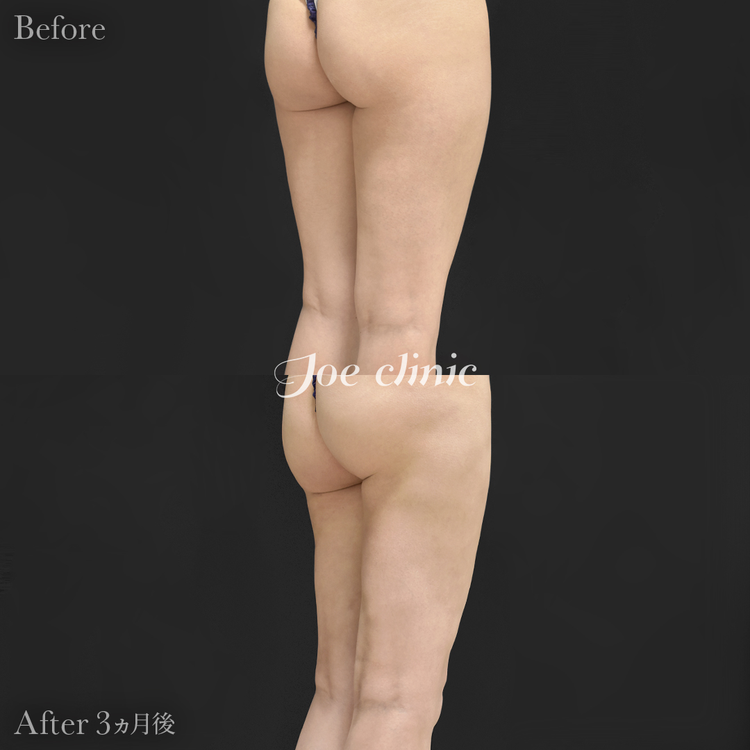 【20代女性】脂肪吸引（大腿全周＋膝周囲）｜3ヵ月後