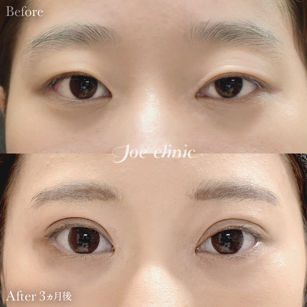 【20代女性】眼瞼下垂（挙筋短縮部分切開法）｜3ヵ月後