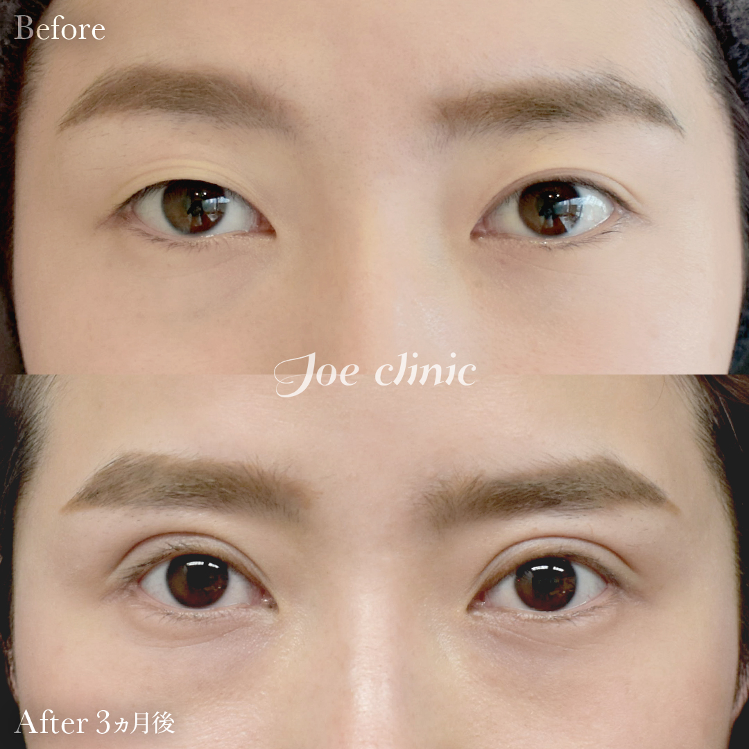 【20代女性】眼瞼下垂（挙筋短縮部分切開法）｜3ヵ月後