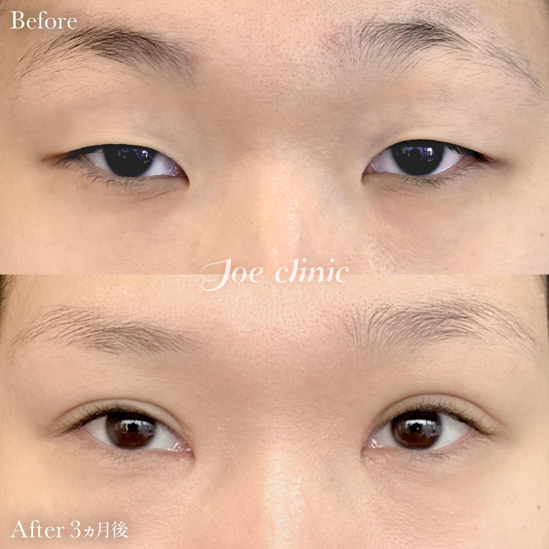【20代女性】眼瞼下垂（挙筋短縮全切開法）＋脂肪取り術＋目頭切開法｜3ヵ月後
