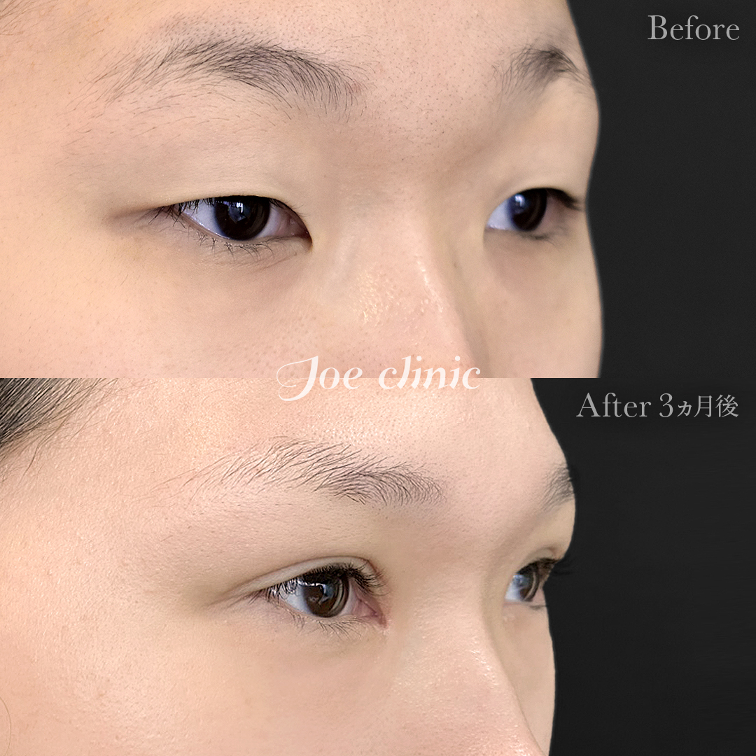 【20代女性】眼瞼下垂（挙筋短縮全切開法）＋脂肪取り術＋目頭切開法｜3ヵ月後