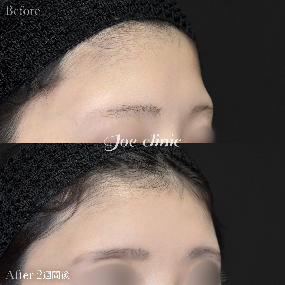 【20代女性】ヒアルロン酸注入（額）｜2週間後