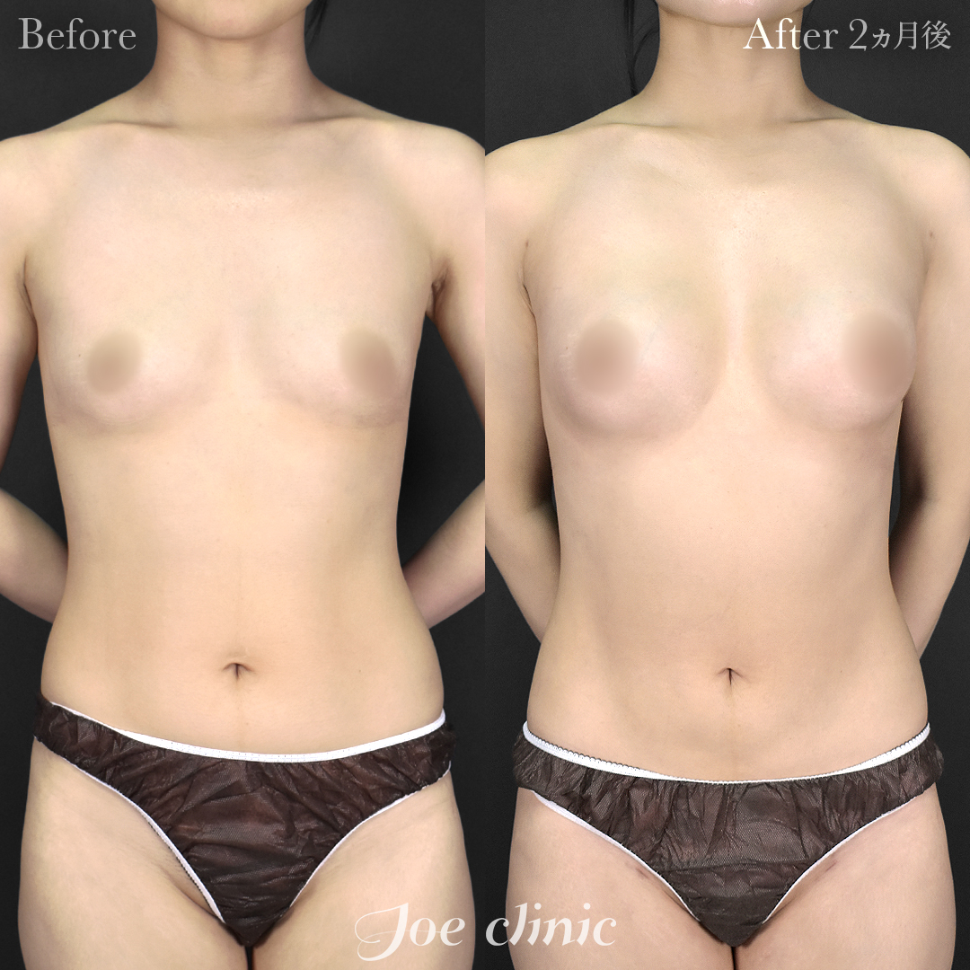 【20代女性】Mia®＋脂肪注入豊胸｜2ヵ月後