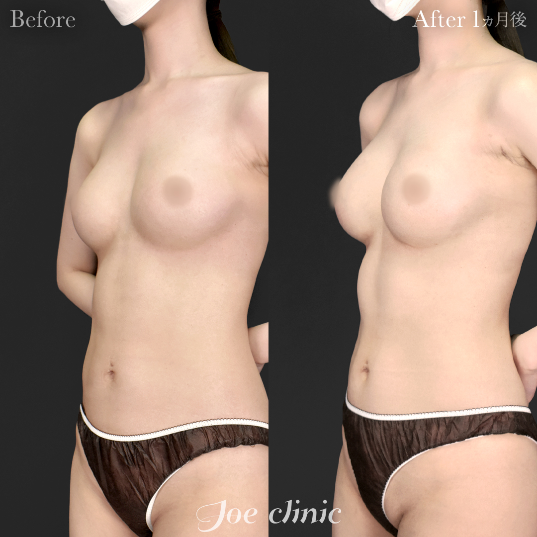 【20代女性・他院修正】他院バッグ入れ替え（325cc×左右）＋脂肪幹細胞注入豊胸｜1ヵ月後
