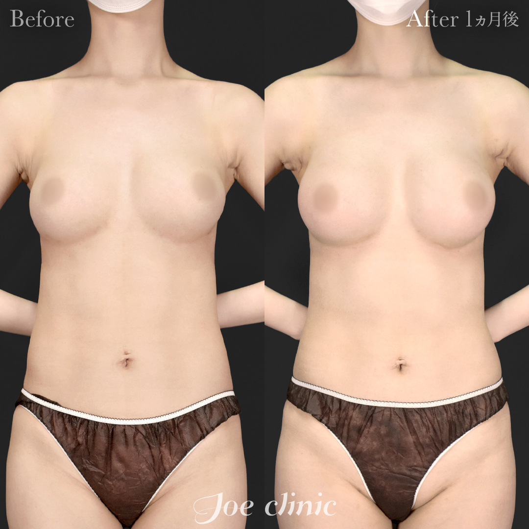 【20代女性・他院修正】他院バッグ入れ替え（325cc×左右）＋脂肪幹細胞注入豊胸｜1ヵ月後