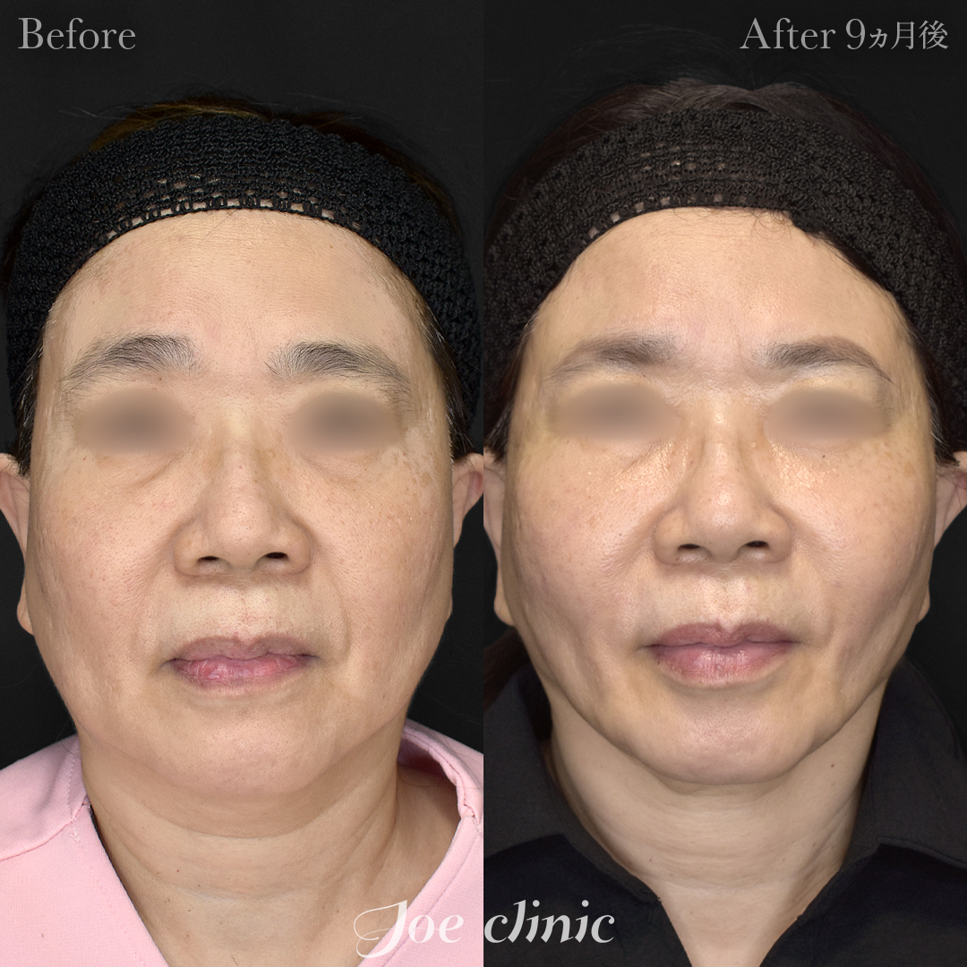 【50代女性】脂肪吸引（フェイスライン＋顎下）＋糸リフト｜9ヵ月後