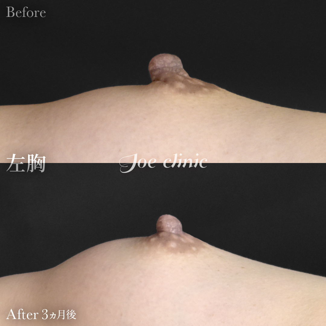 【40代女性】乳頭縮小術｜3ヵ月後