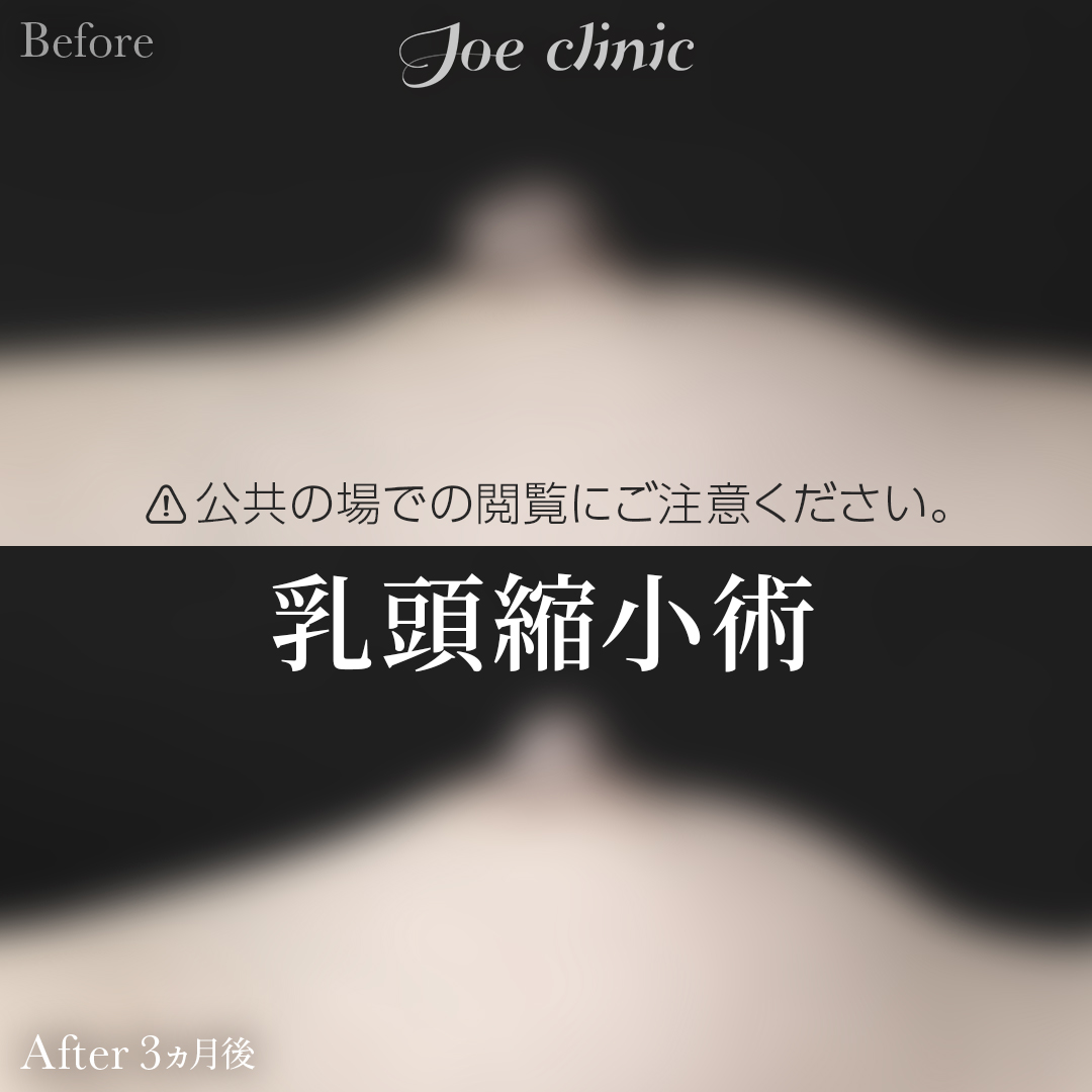 【40代女性】乳頭縮小術｜3ヵ月後