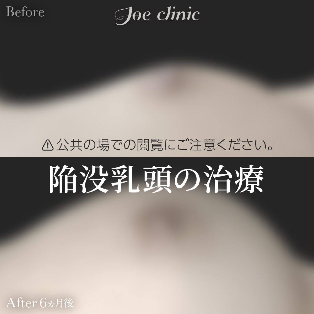 【20代女性】陥没乳頭の治療｜6ヵ月後