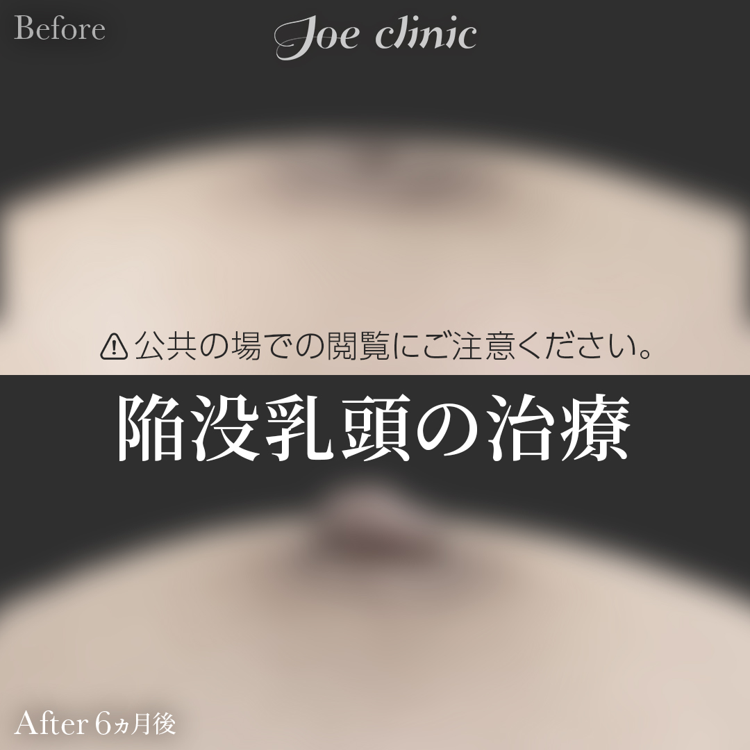 【20代女性】陥没乳頭の治療（酒井Ⅱ法）｜6ヵ月後