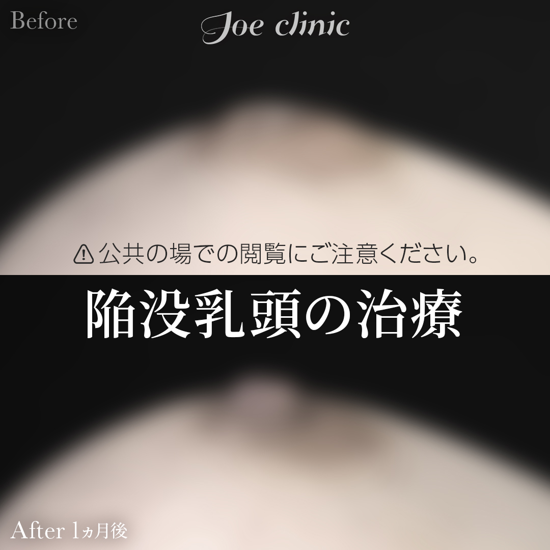【20代女性】陥没乳頭の治療｜1ヵ月後