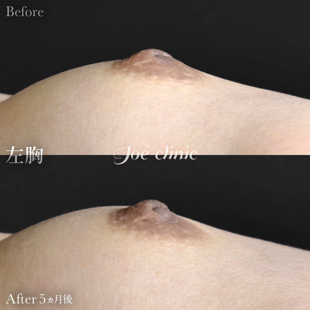 【20代女性】陥没乳頭の治療｜5ヵ月後