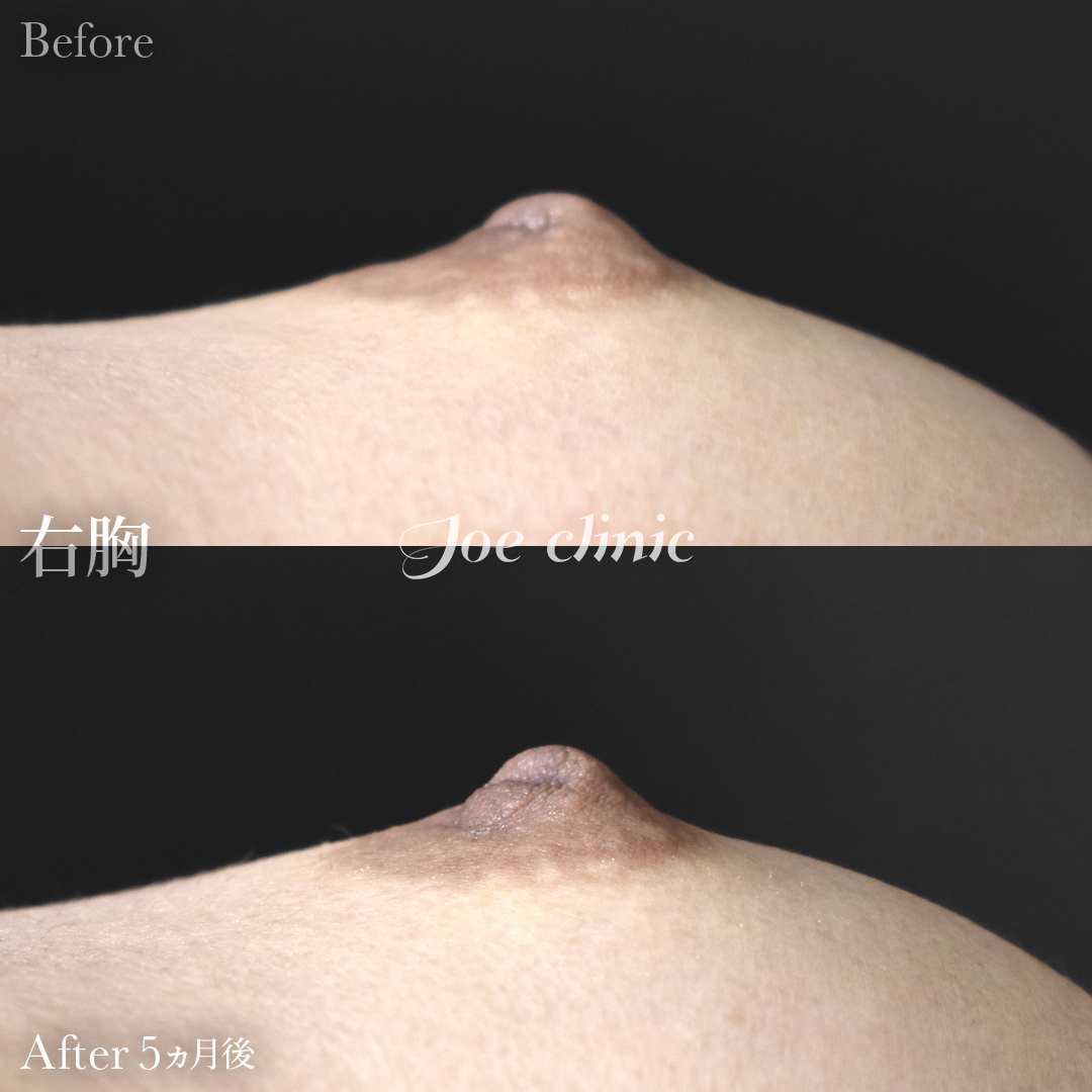 【20代女性】陥没乳頭の治療｜5ヵ月後