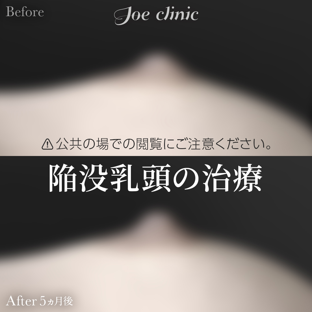 【20代女性】陥没乳頭の治療｜5ヵ月後