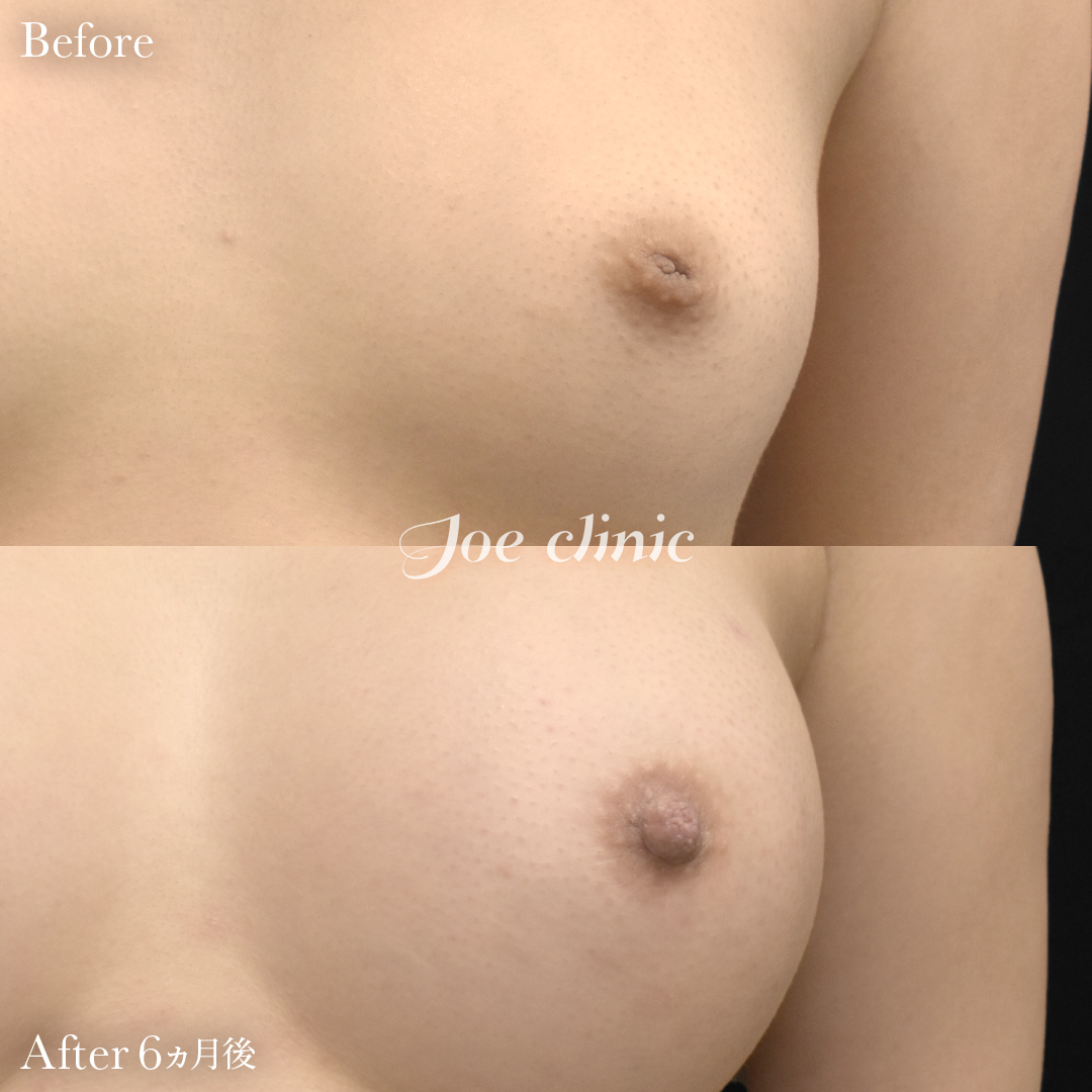 【20代女性】陥没乳頭の治療｜6ヵ月後