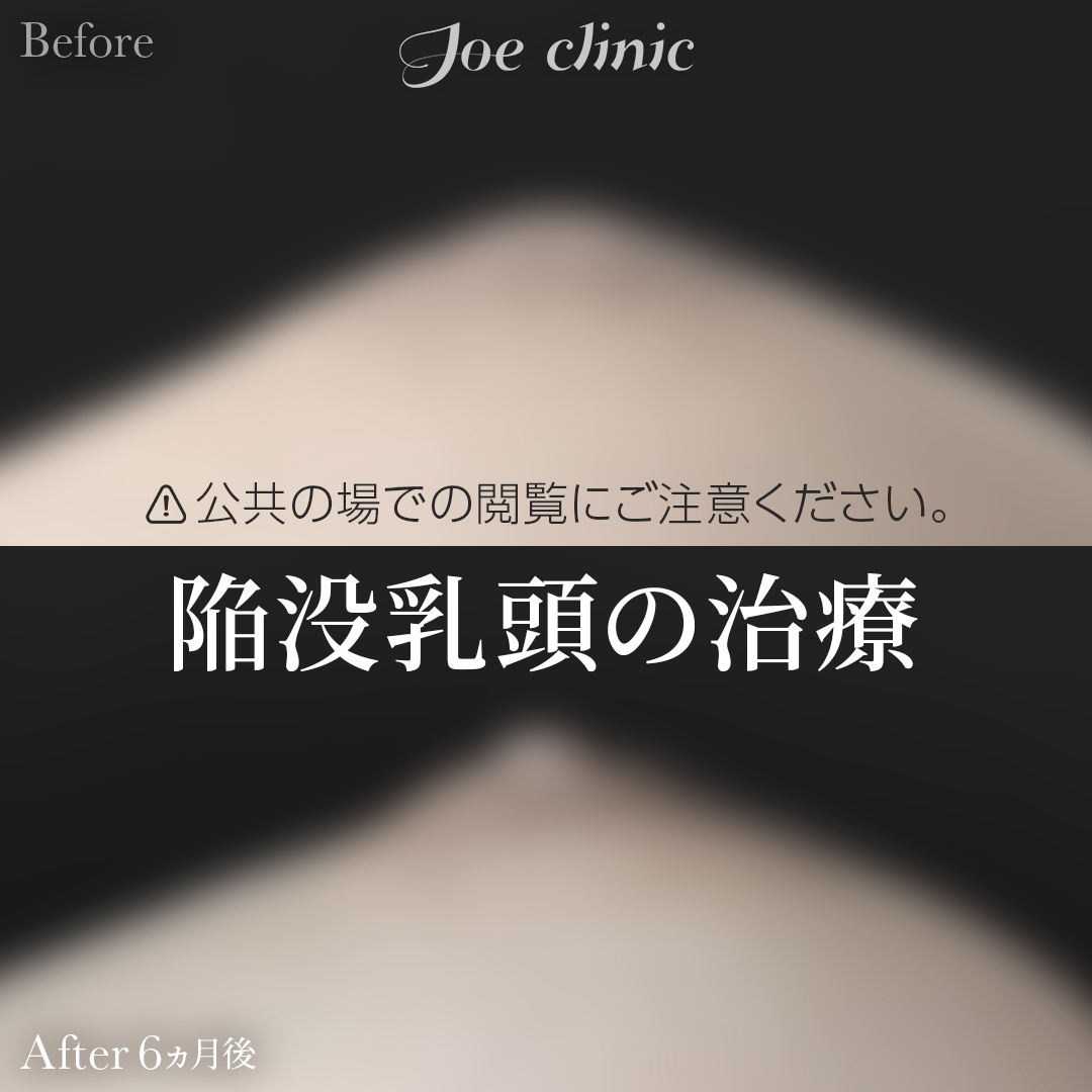 【30代女性】陥没乳頭の治療（酒井法）｜6ヵ月後