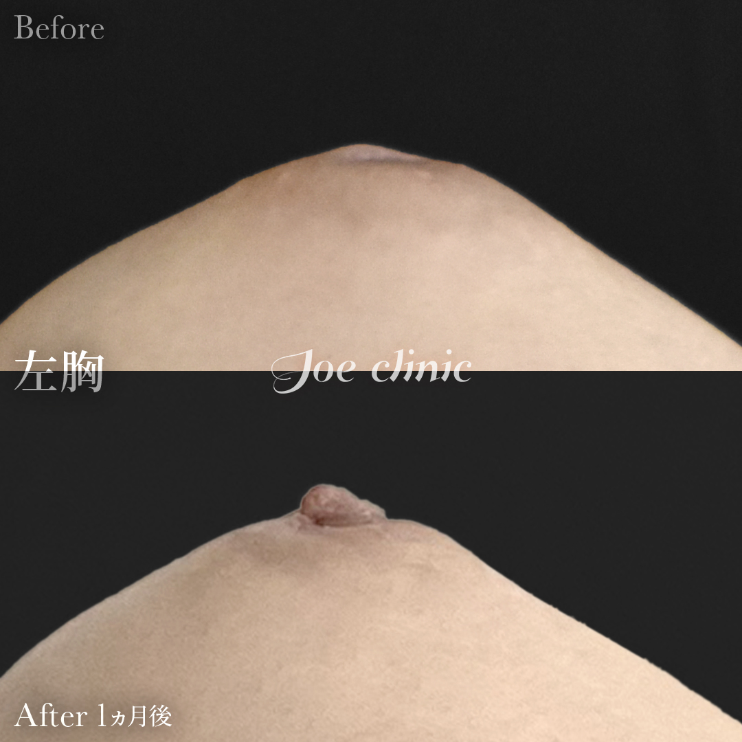 【20代女性】陥没乳頭の治療｜1ヵ月後