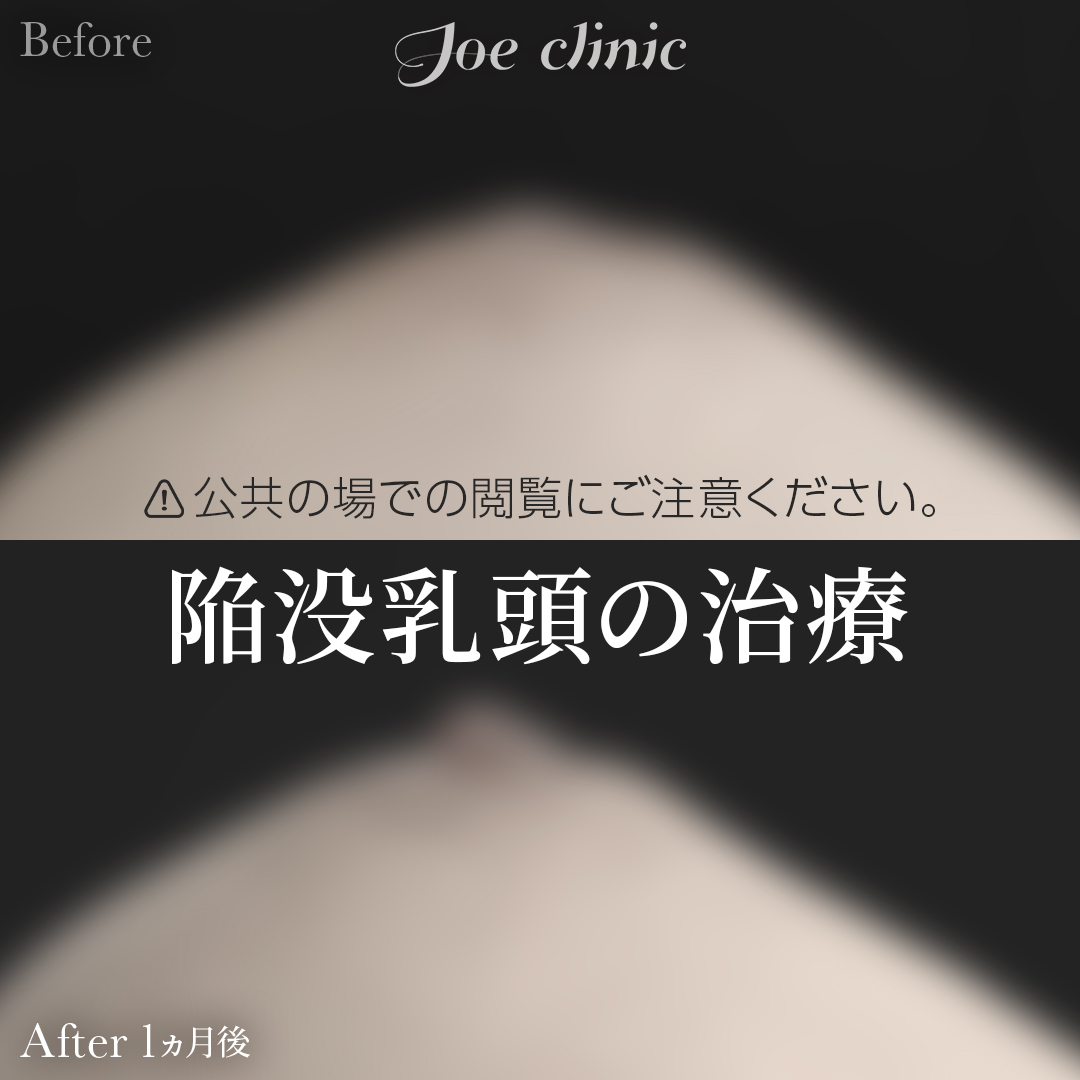 【20代女性】陥没乳頭の治療｜1ヵ月後
