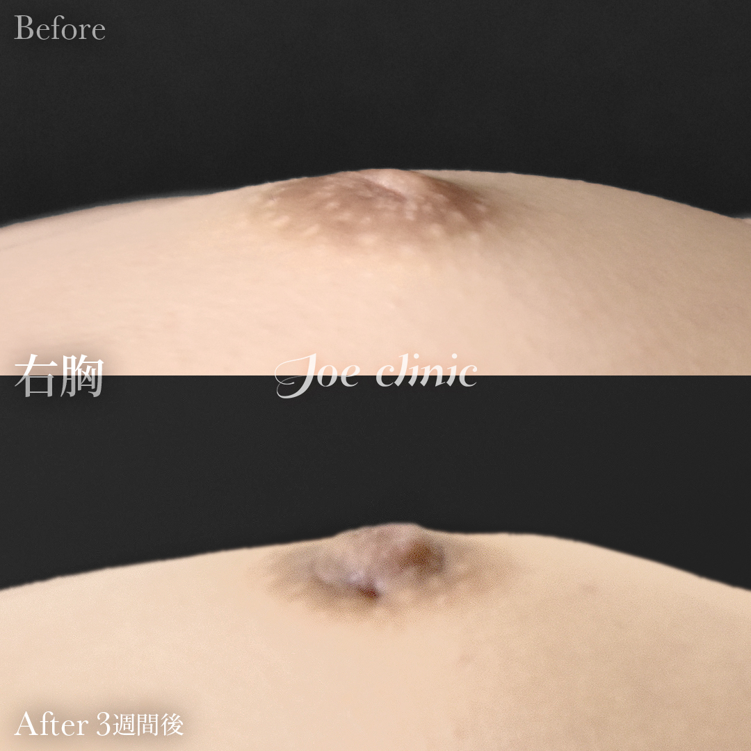 【20代女性】陥没乳頭の治療｜3週間後