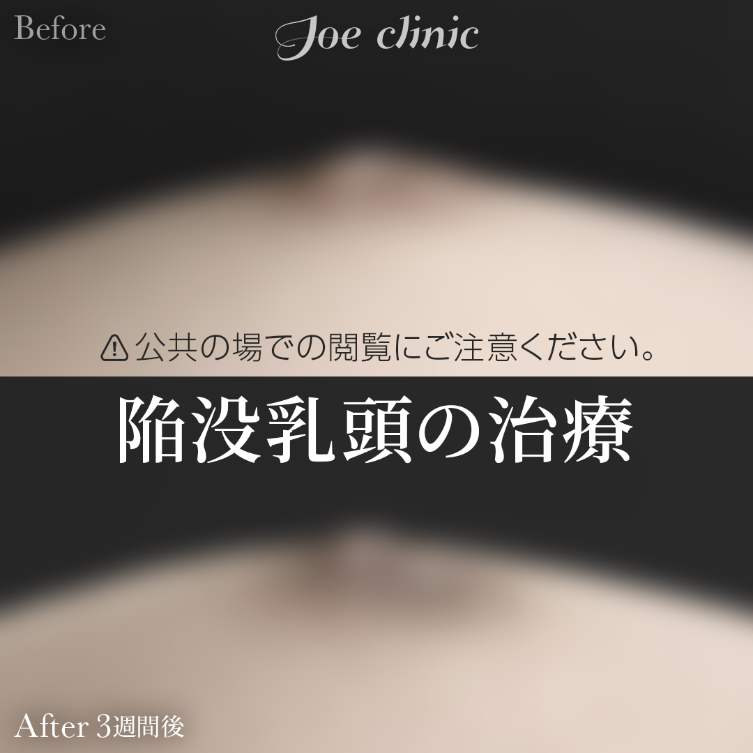 【20代女性】陥没乳頭の治療｜3週間後
