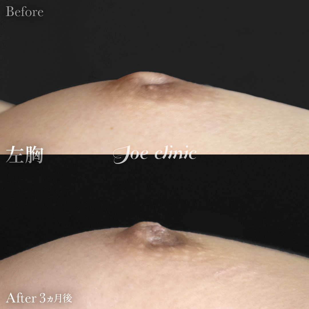 【20代女性】陥没乳頭の治療（酒井法）｜3ヵ月後