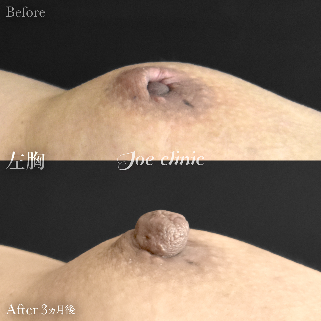 【40代女性】陥没乳頭の治療｜3ヵ月後