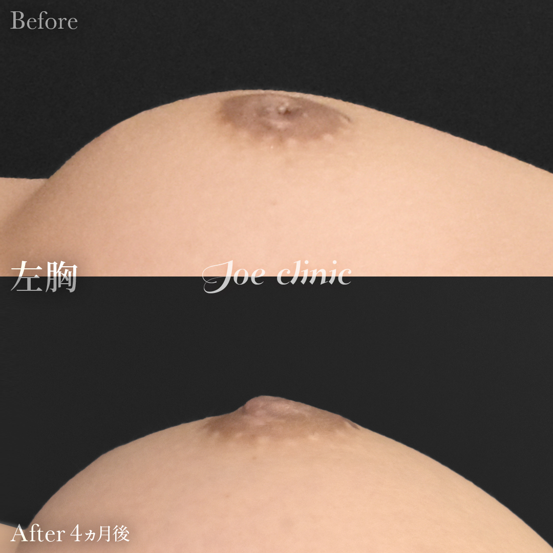 【30代女性】陥没乳頭の治療｜4ヵ月後