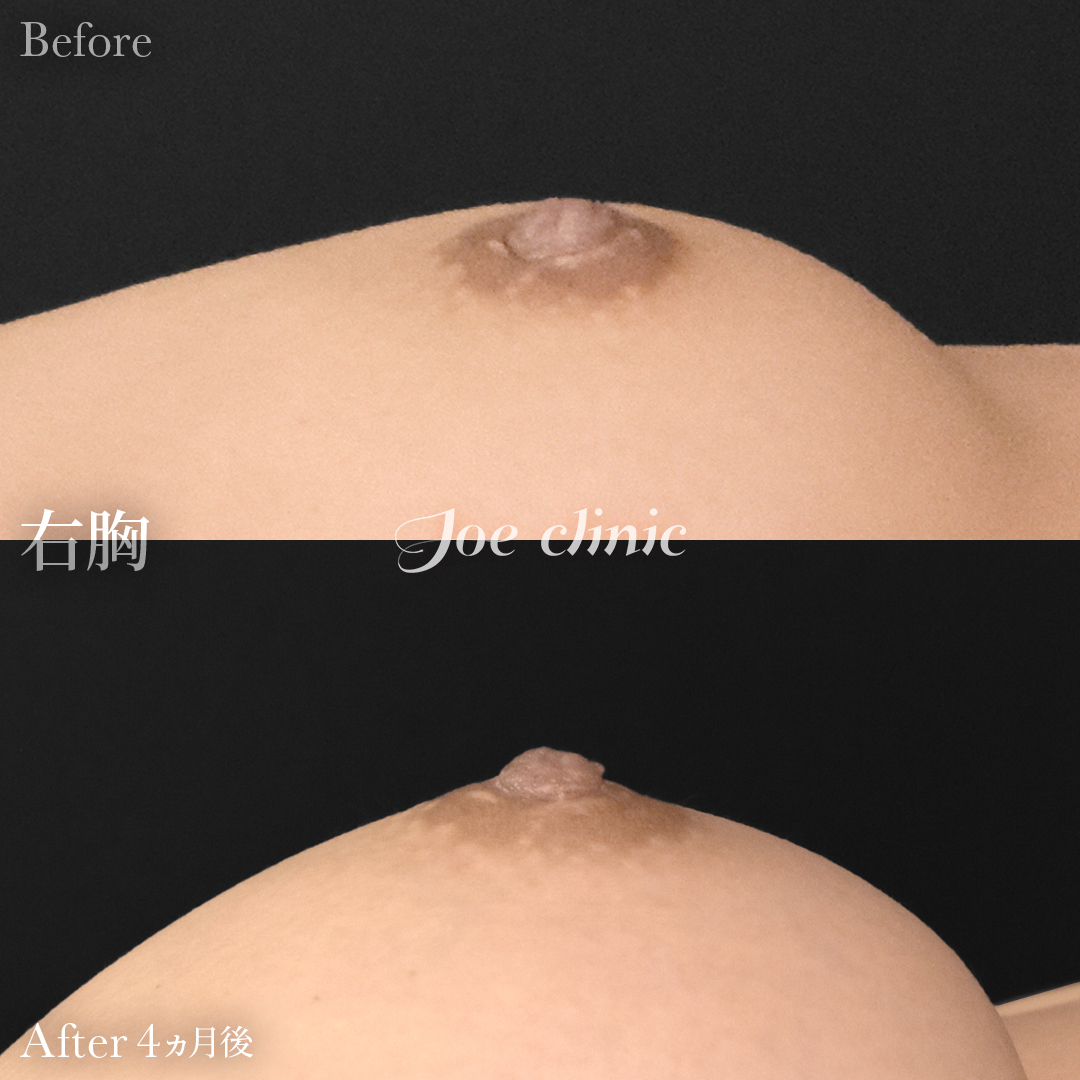 【30代女性】陥没乳頭の治療｜4ヵ月後