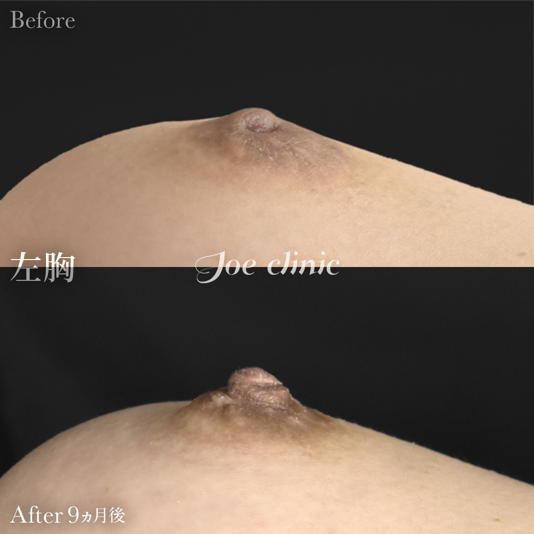 【20代女性】陥没乳頭の治療（酒井法）｜9ヵ月後
