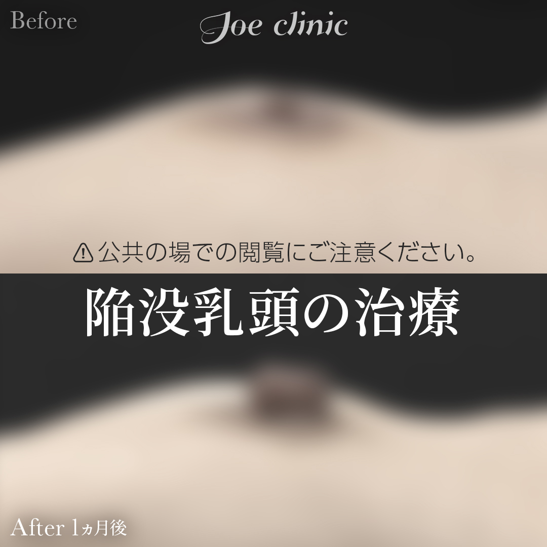 【20代女性】陥没乳頭の治療（酒井法）｜1ヵ月後