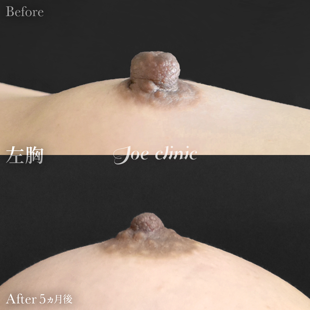 【50代女性】乳頭縮小術｜5ヵ月後