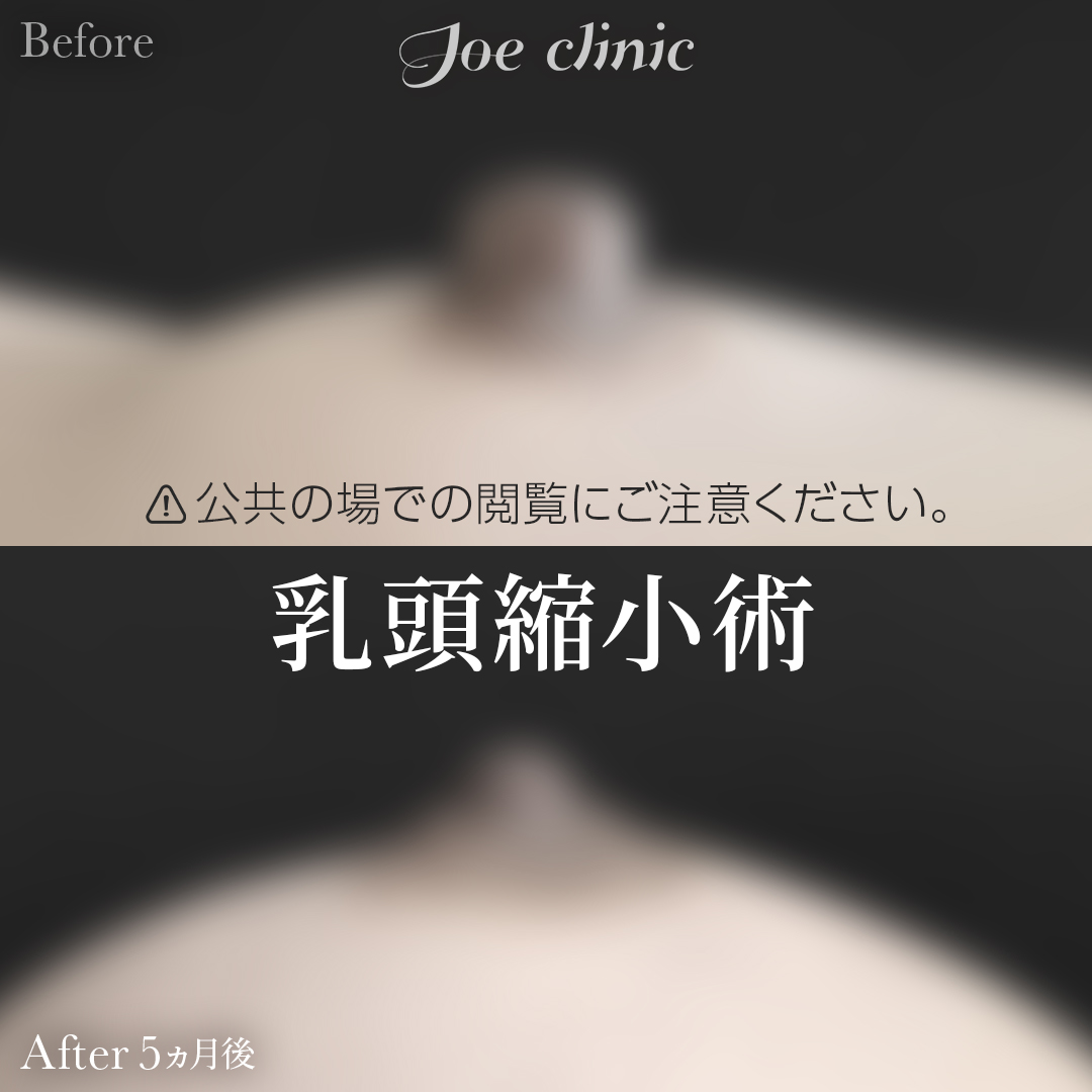 【50代女性】乳頭縮小術｜5ヵ月後