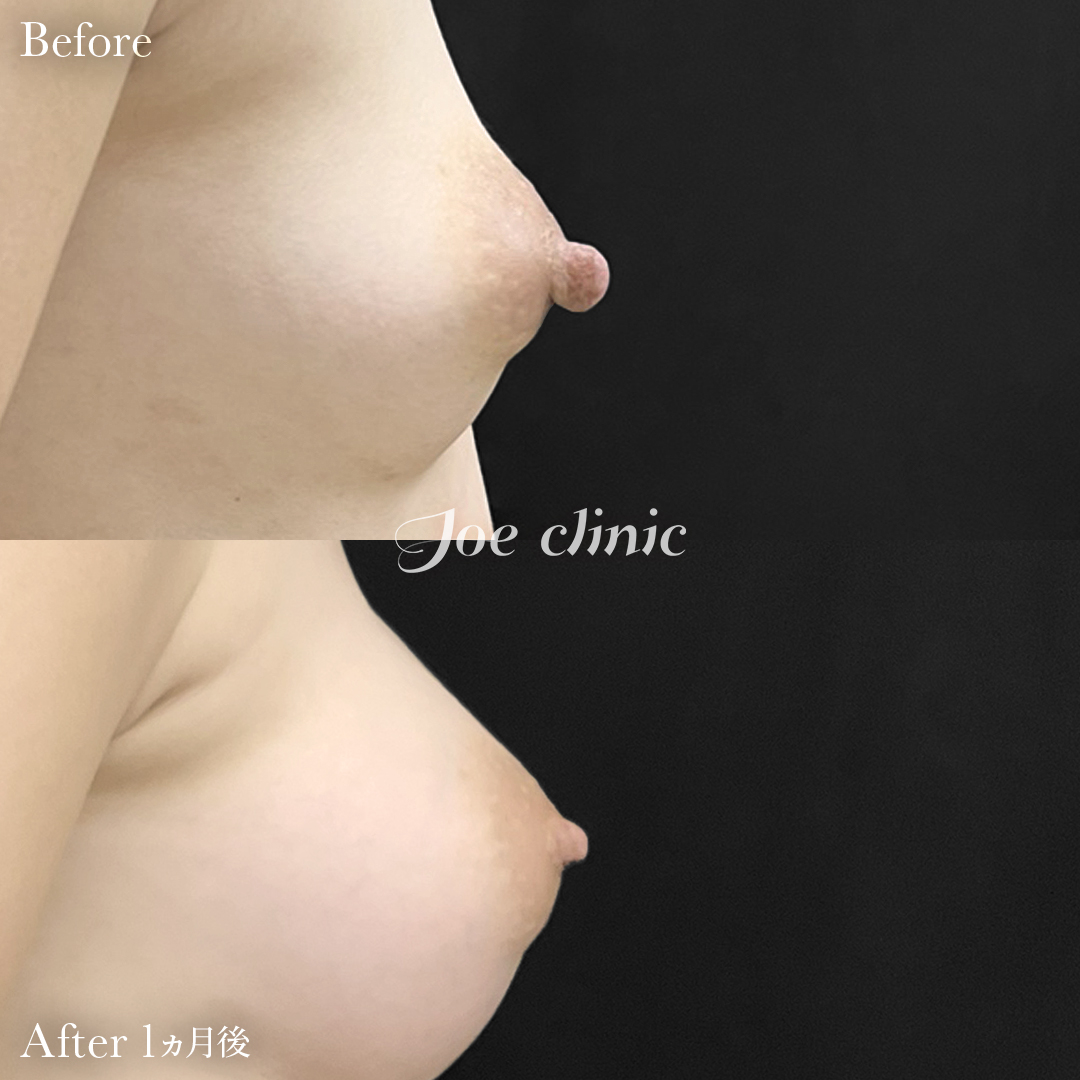 【30代女性】乳頭縮小術｜1ヵ月後