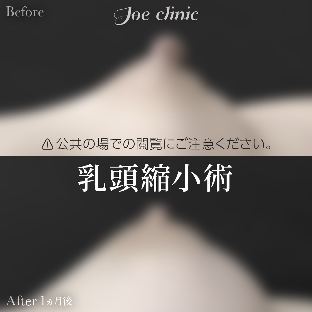 【30代女性】乳頭縮小術｜1ヵ月後