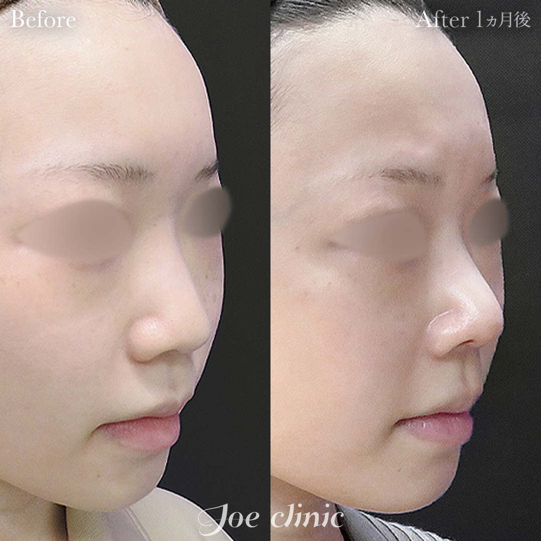 【20代女性】鼻フルコース（鼻複合自家組織移植術）｜1ヵ月後