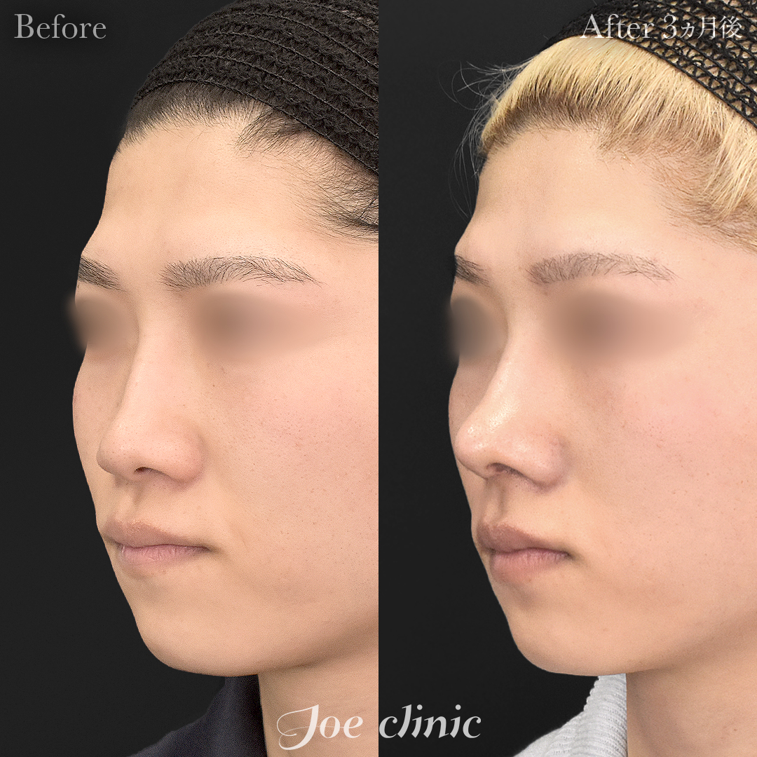 【30代男性】鼻フルコース＋自家組織移植術＋超音波鼻骨骨切り幅寄せ術｜3ヵ月後