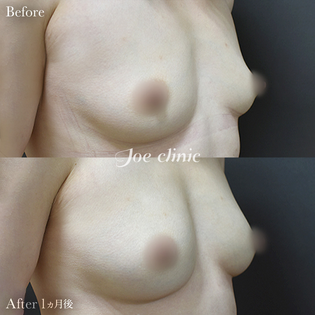 【30代女性】脂肪幹細胞注入豊胸（250cc×左右）│1ヵ月後
