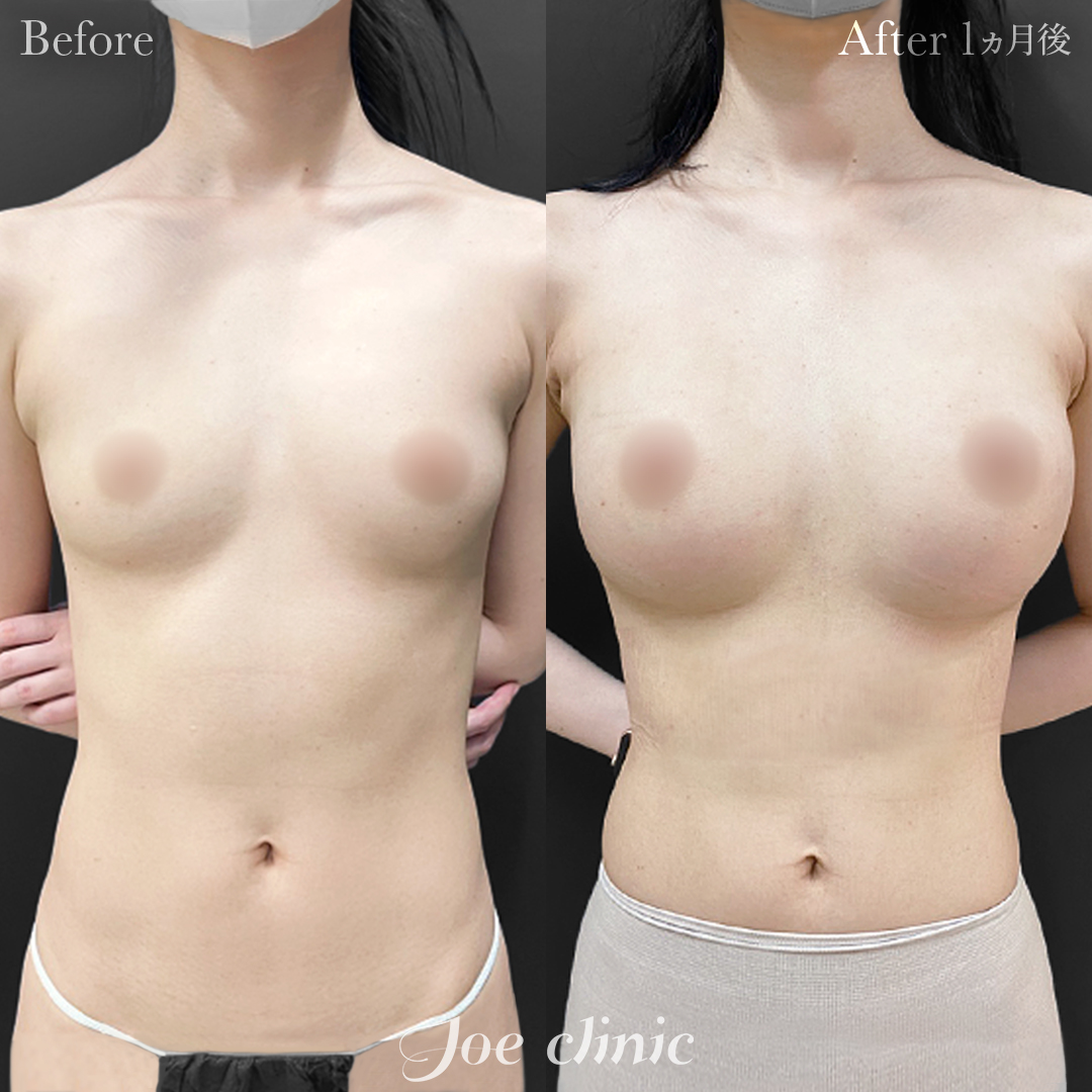 【30代女性】ハイブリッド豊胸（シリコンバッグ豊胸＋脂肪幹細胞注入豊胸）｜1ヵ月後