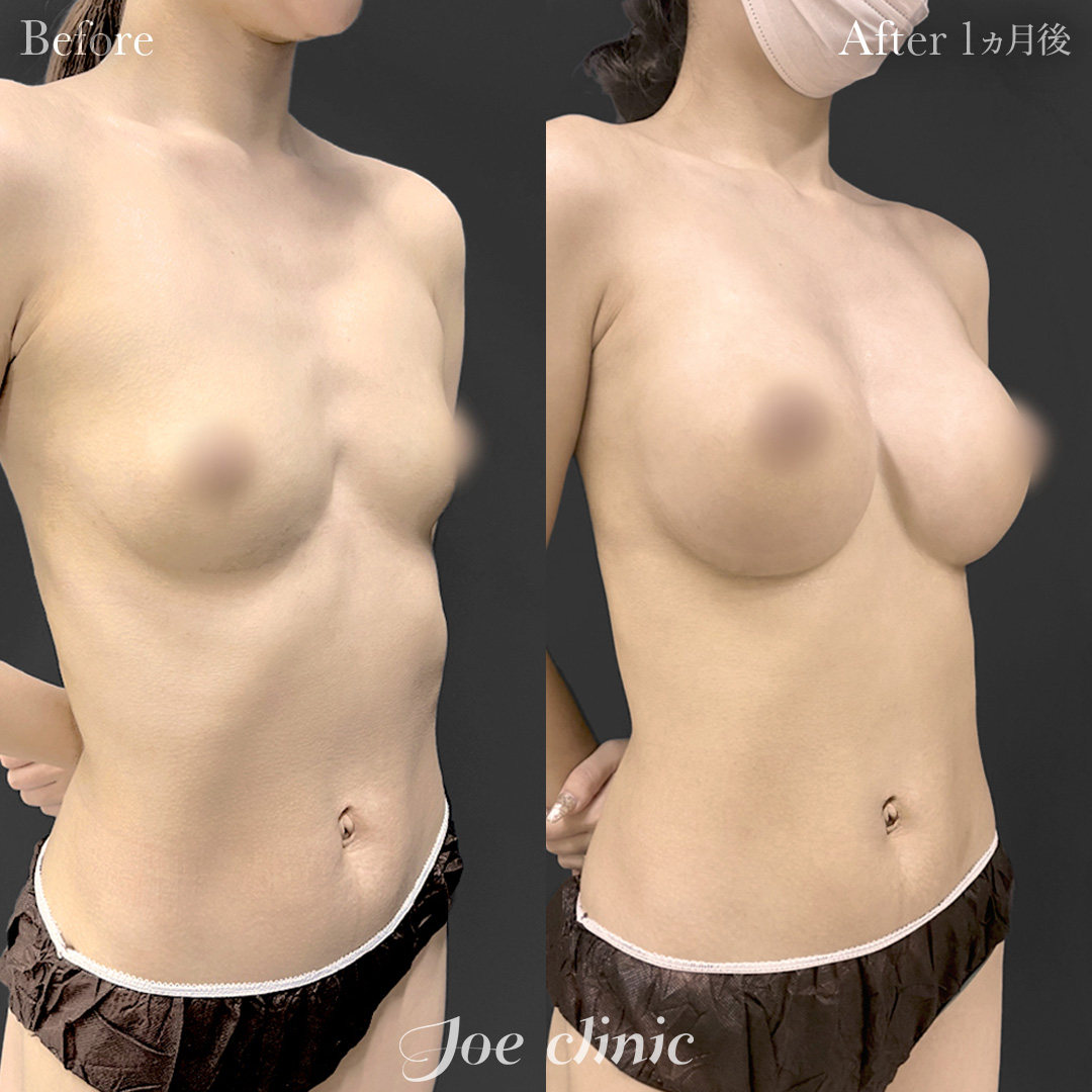 【20代女性】シリコンバッグ豊胸（320cc×左右）｜1ヵ月後