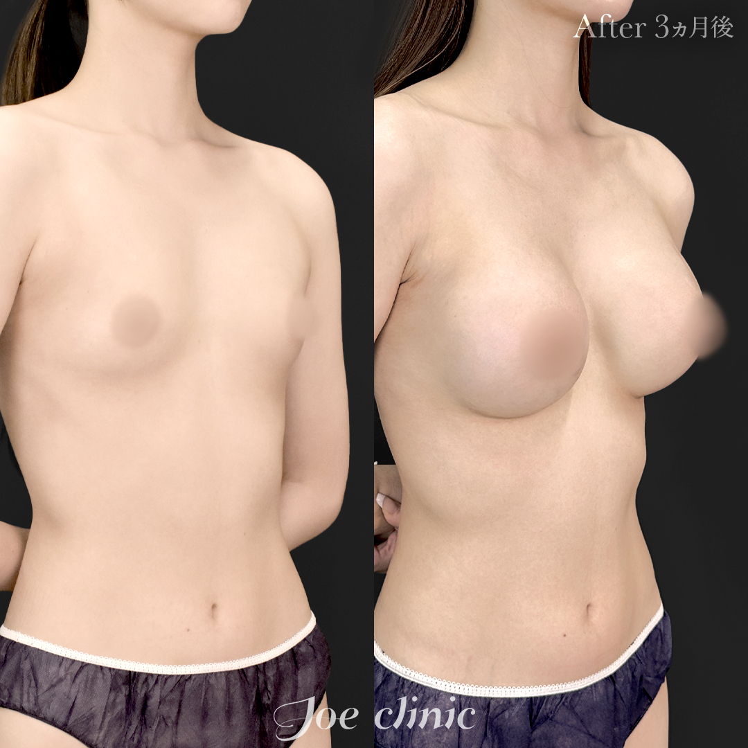 【40代女性】シリコンバッグ豊胸モティバ2（360cc×左右）｜3ヵ月後