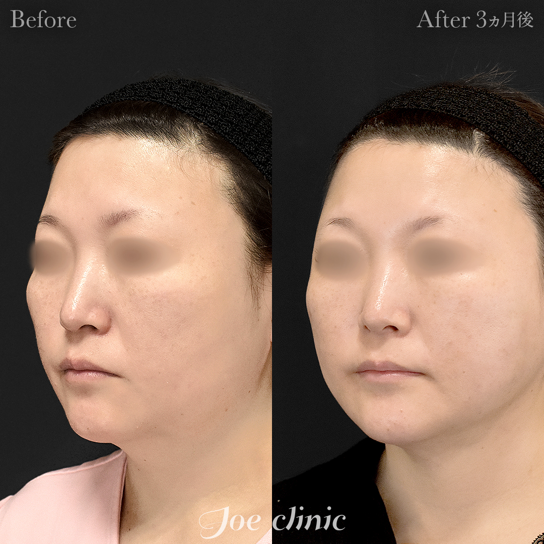 【40代女性】脂肪吸引（フェイスライン・顎下）｜3ヵ月後