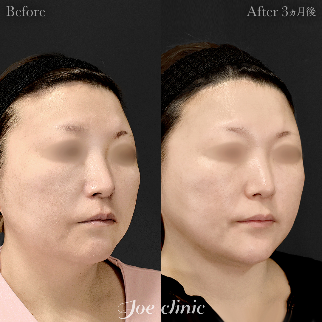 【40代女性】脂肪吸引（フェイスライン・顎下）｜3ヵ月後