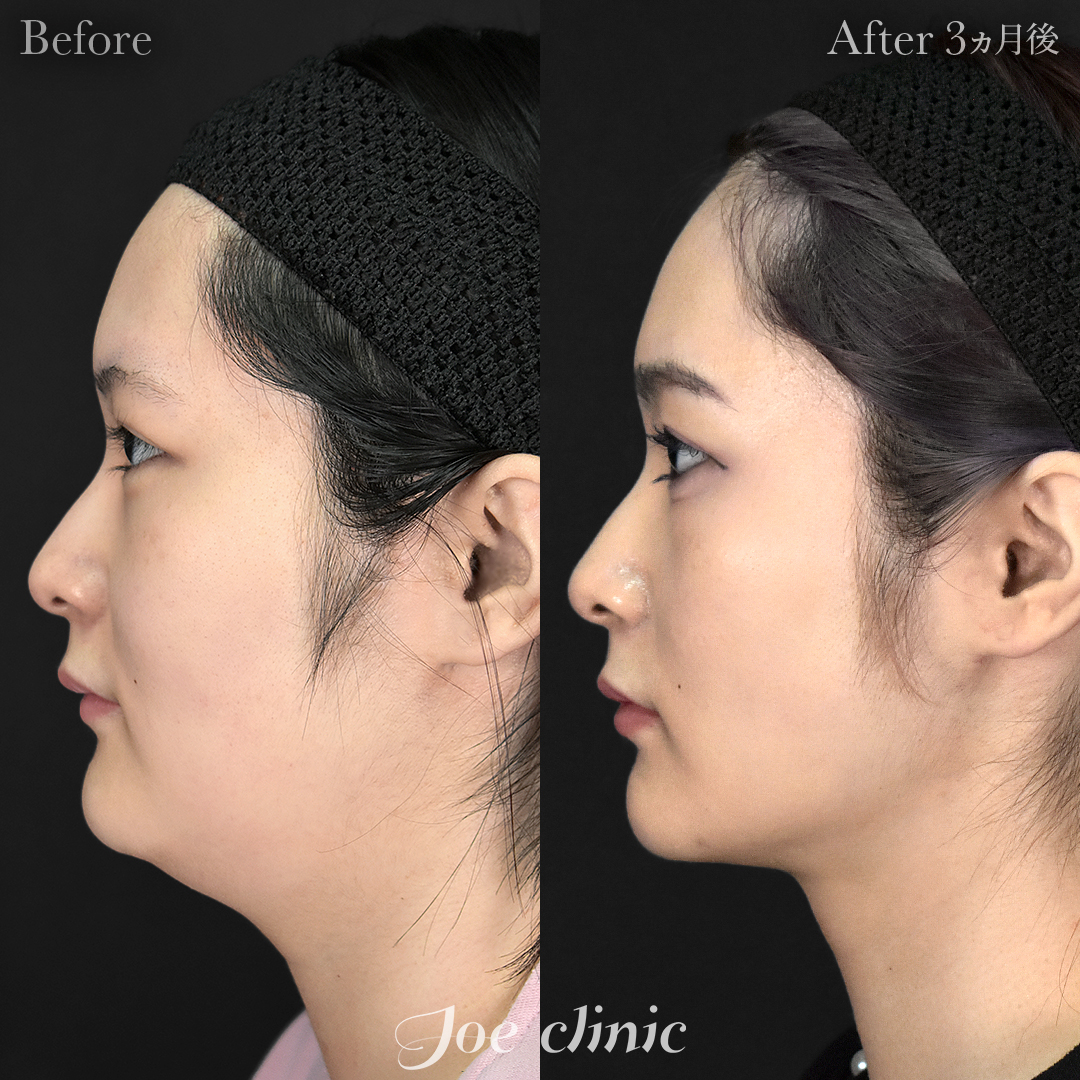 【20代女性】脂肪吸引（フェイスライン＋顎下）＋糸リフト｜3ヵ月後