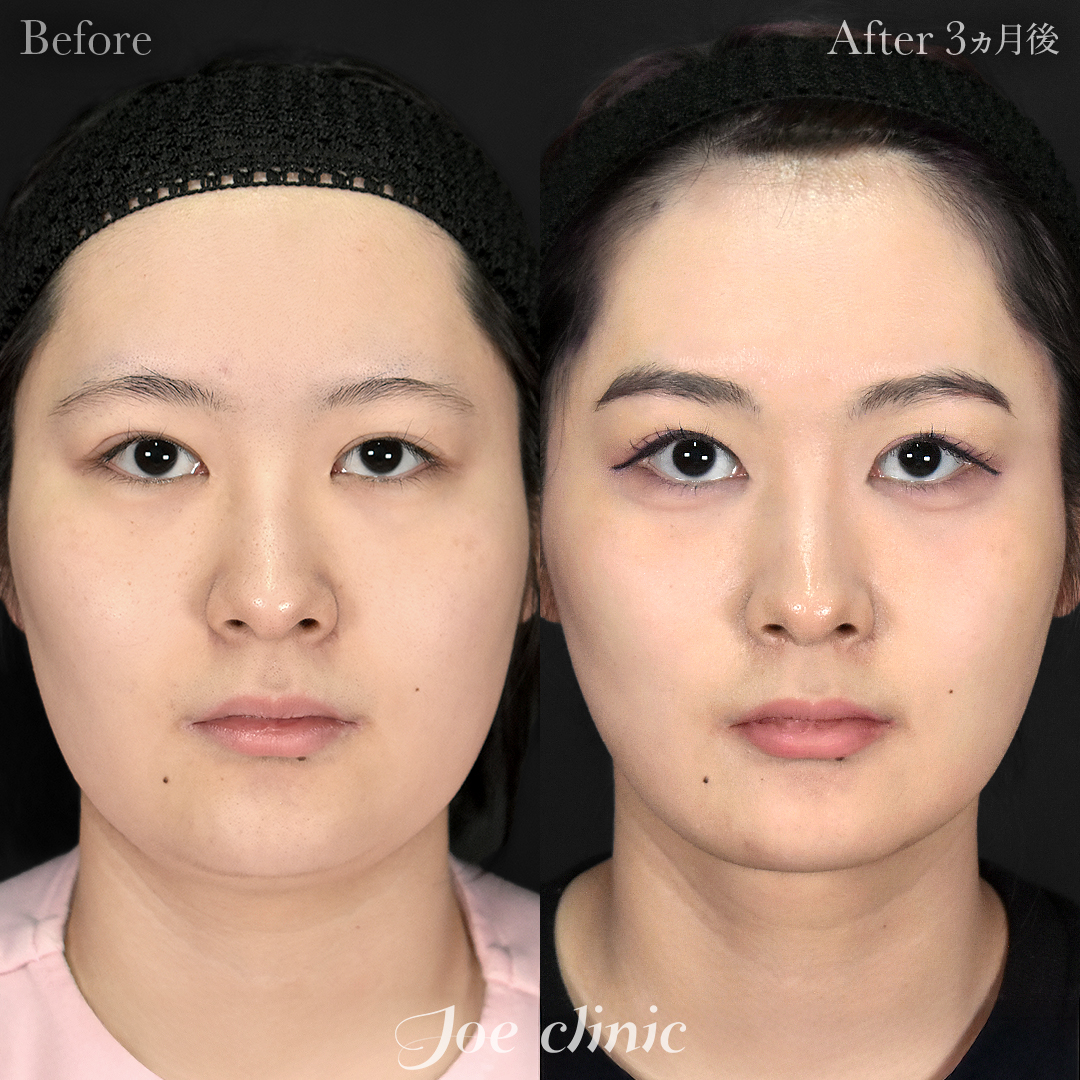 【20代女性】脂肪吸引（フェイスライン＋顎下）＋糸リフト｜3ヵ月後