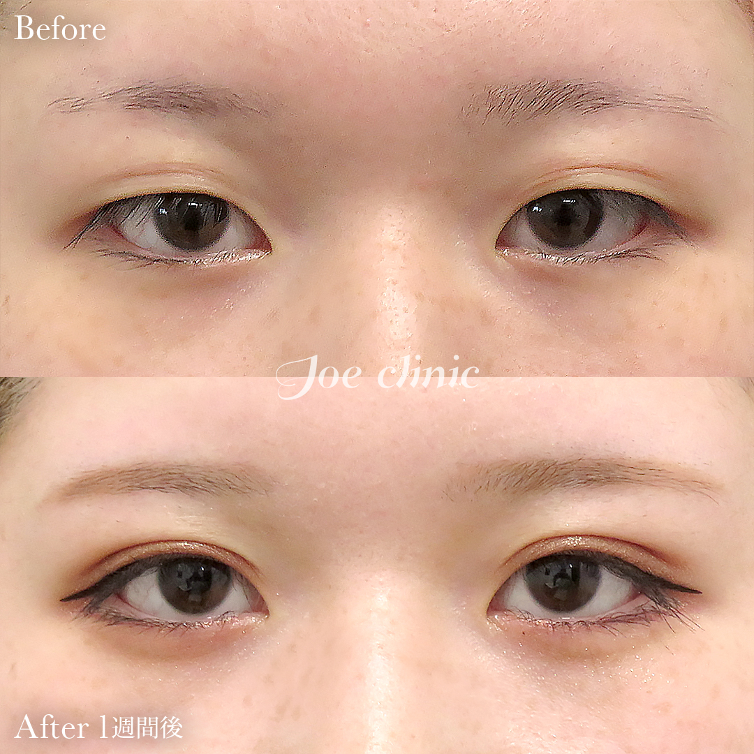 【10代女性】ジョウクリ式二重埋没法2点留め｜1週間後